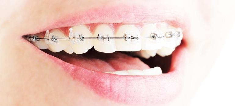 Jak aparaty ortodontyczne wpływają na zęby