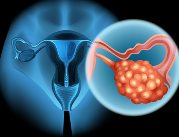Nowy test w leczeniu raka jajnika
