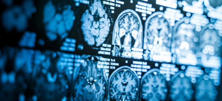 Pojedynczy skan mózgu może pomóc w diagnozie choroby Alzheimera