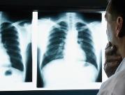Eksperci: mamy postęp w leczeniu raka płuca, ale...