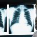 Konieczność podejścia interdyscyplinarnego w raku płuca